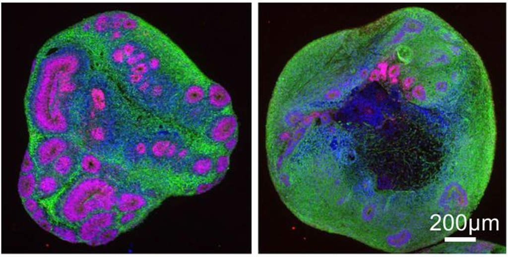 Los recientes avances han permitido a los científicos desarrollar neuronas en 3D, modelando un "minicerebro". En este estudio, se encontró que los minicerebros EH de inicio juvenil (derecha) tenían menos estructuras internas y más pequeñas, mostradas aquí en rosa, en comparación con los organoides que representan a alguien sin EH (izquierda).  