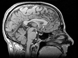 Las moléculas de proteína huntingtina con demasiadas glutaminas no pueden ensamblarse correctamente, por lo que forman agregados tóxicos que se ha demostrado que se acumulan en el cerebro de los pacientes con el tiempo. Sin embargo, estos acúmulos no son visibles en la mayoría de los tipos de escáneres cerebrales como las resonancias magnéticas.