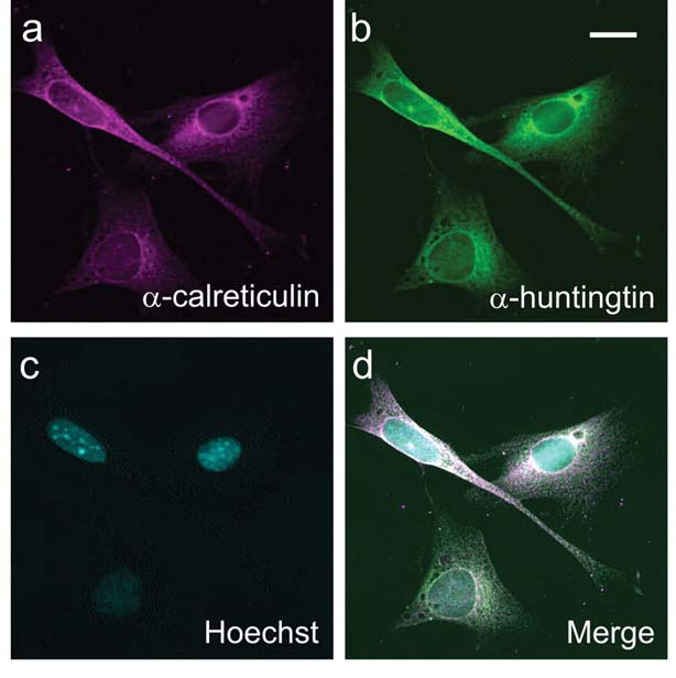 En esta imagen de microscopio del laboratorio de Truant, se utilizan diferentes colores para mostrar diferentes partes de la célula. El núcleo se revela mediante un tinte llamado 'Hoechst'. La huntingtina ha sido hecha para brillar de color verde, lo que permite que se localice en la célula.