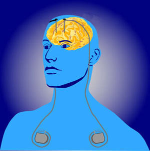 La estimulación cerebral profunda implica la colocación de pequeños electrodos a través del cráneo hasta el cerebro. Los generadores de impulsos colocados debajo de la piel envían impulsos eléctricos al cerebro.