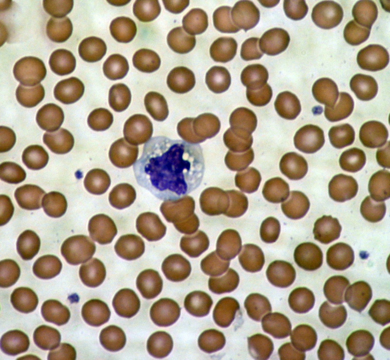 Imagen microscópica de las células sanguíneas - los glóbulos rojos rodeando una célula del sistema inmune.