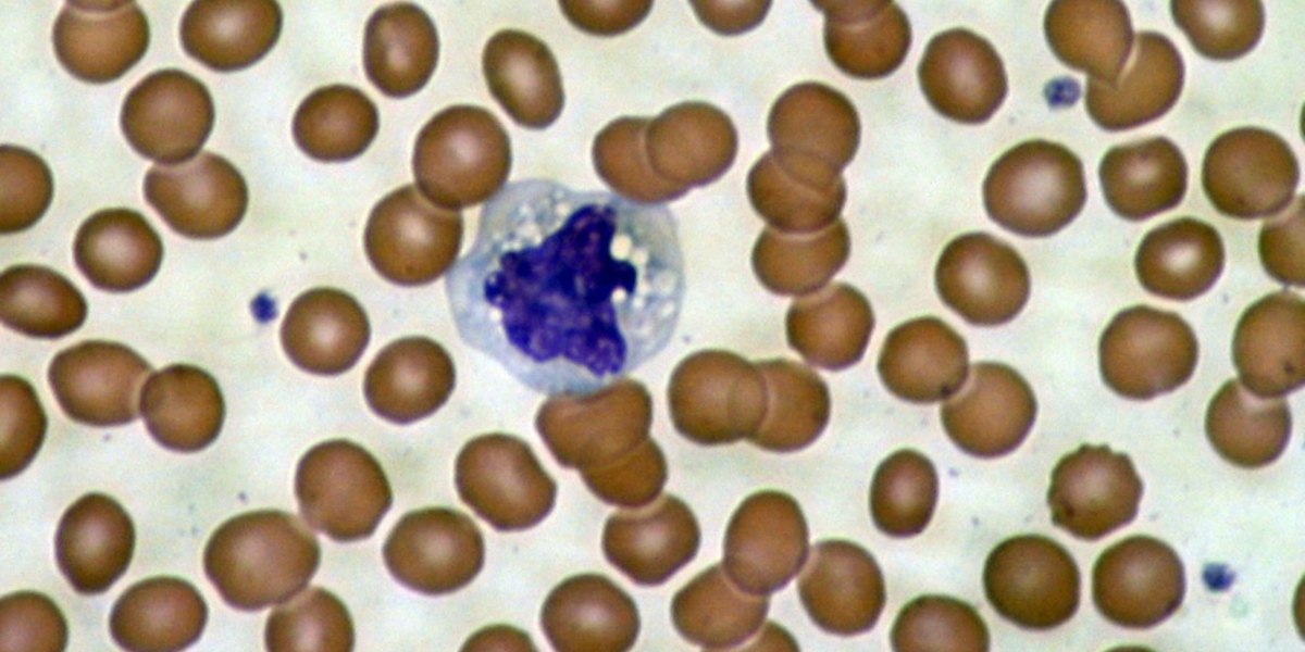 Iluminando los hallazgos en las células sanguíneas de los pacientes con enfermedad de Huntington