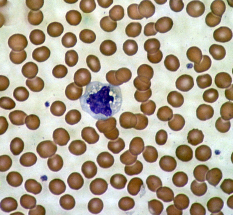 Imagen microscópica de las células sanguíneas - los glóbulos rojos rodeando una célula del sistema inmune.  