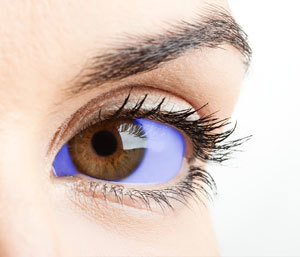 Como se muestra en esta impresión artística, el azul de metileno colorea el blanco de los ojos de azul. Esto puede traer problemas al estudiar el fármaco debido al efecto placebo.  