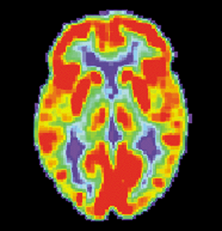 Los escáneres FDG-TEP nos ayudan a observar cuánto azúcar consume cada parte del cerebro. Esto es un escáner de un cerebro sano. Las áreas rojas son las qeu más azúcar están consumiendo-  