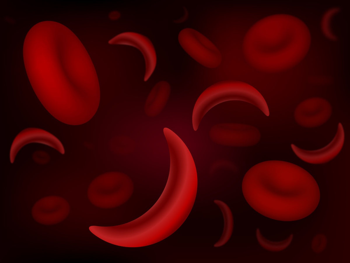 La anemia de células falciformes hace que los glóbulos rojos adopten una forma de "C" o de hoz. Las personas con esta enfermedad carecen de una proteína que les da a los glóbulos rojos una forma rígida que les ayuda a transportar oxígeno por todo el cuerpo. Llevar menos oxígeno significa que las personas con anemia de células falciformes tienen menos glóbulos rojos y pueden experimentar obstrucción de los vasos sanguíneos y, potencialmente, un derrame cerebral.  